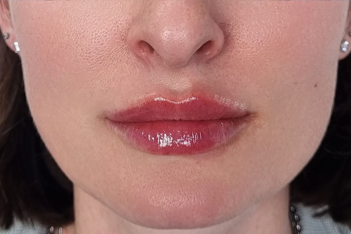 Resultado de un relleno de labios con ácido hialurónico