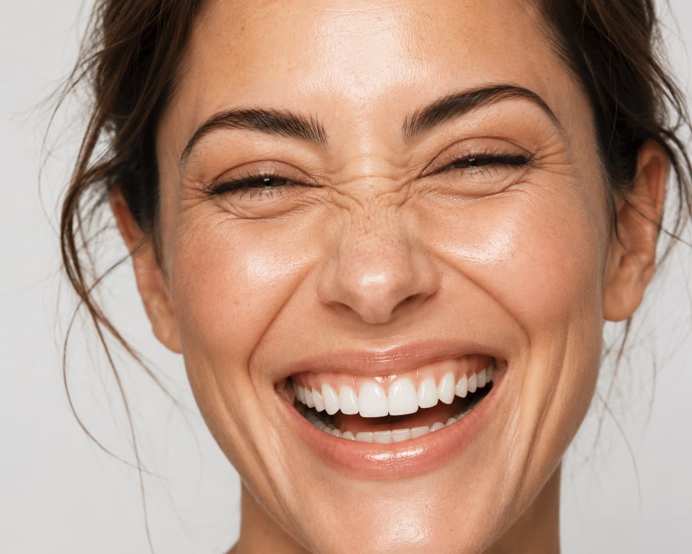 Toxina botulínica para sonrisa gingival
